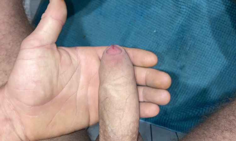 Frenuloplastika a následně obřízka - 59649