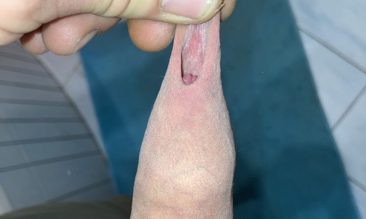 Frenuloplastika a následně obřízka - 59650
