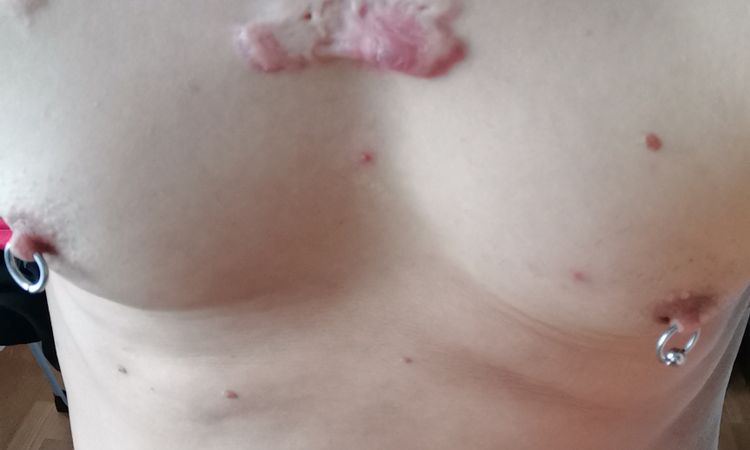 Je to keloidni jizva. Poslední dobou mě poboliva a svedi. - 60273