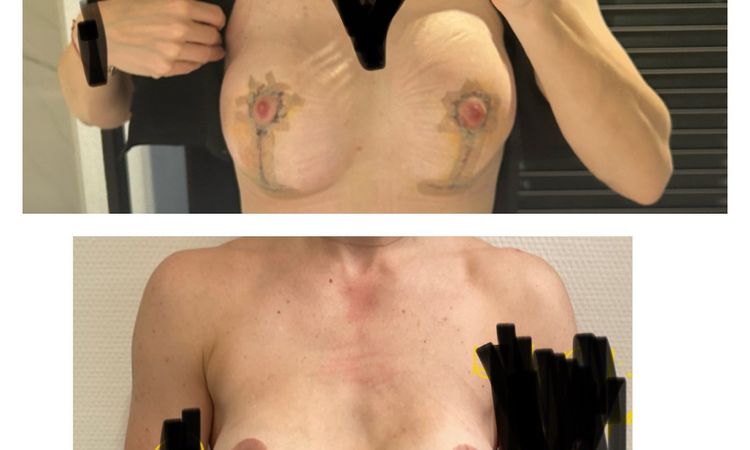 Modelace s implantáty - 61112