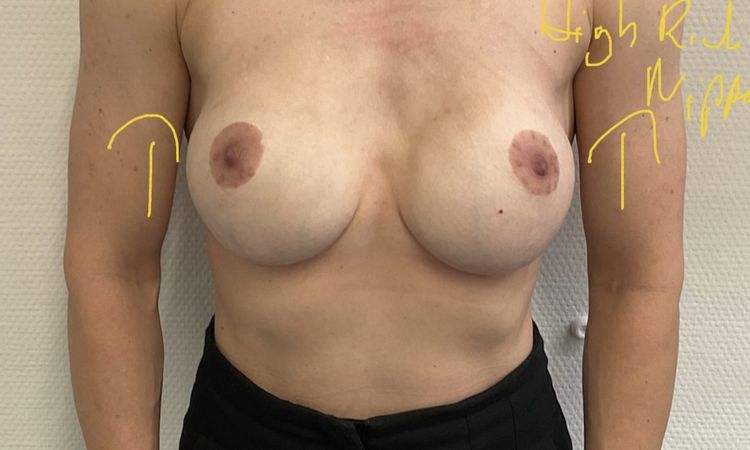 Modelace s implantáty - 61113
