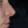Křivé nosní dírky po operaci