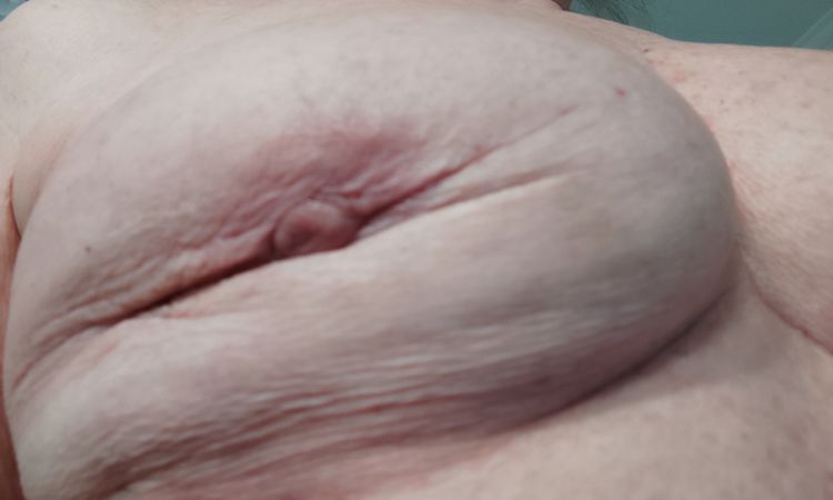Deformace po vyjmuti prsniho implantatu - 61566