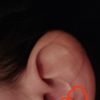 Operácia chrupaviek na uchu