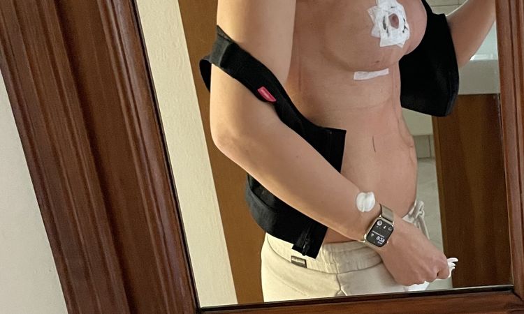 Až se vše zahojí budou prsa přirozená ? - 62330