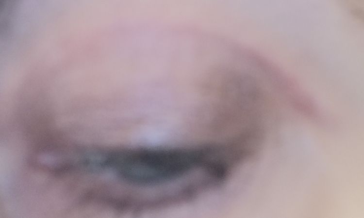 Blefaroplastika, hojení jizev - 63429