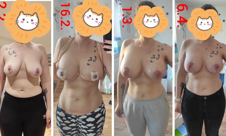 Augmentace prsou, povadla prsa 2 měsíce po operaci - 64104