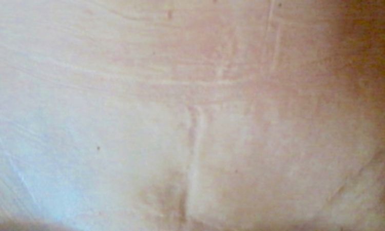 "Brazilska" abdominoplastika - 64346