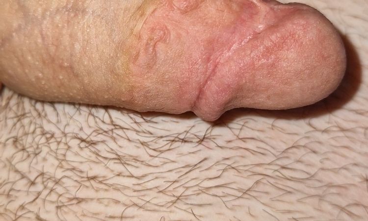 Přebytečná kůže a srůsty po obřízce - 64896