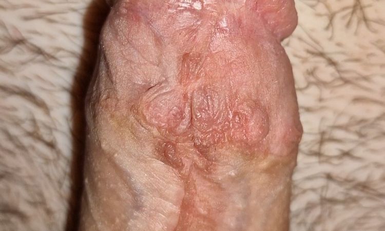 Přebytečná kůže a srůsty po obřízce - 64897