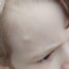 Podkožní boulička na čele u dítěte