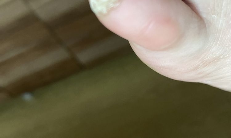 Nevím,zda-li se jedná o nehtovou mykózu. - 67020