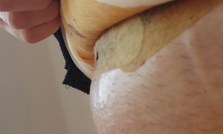 Voda nebo serom po abdominoplastice - 68613