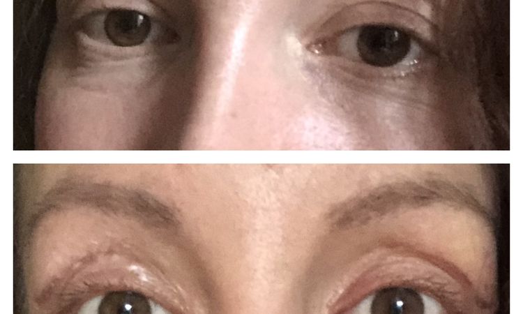 Blefaroplastika místo řezu - 69031