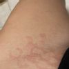 Laserová epilace- spálení kůže