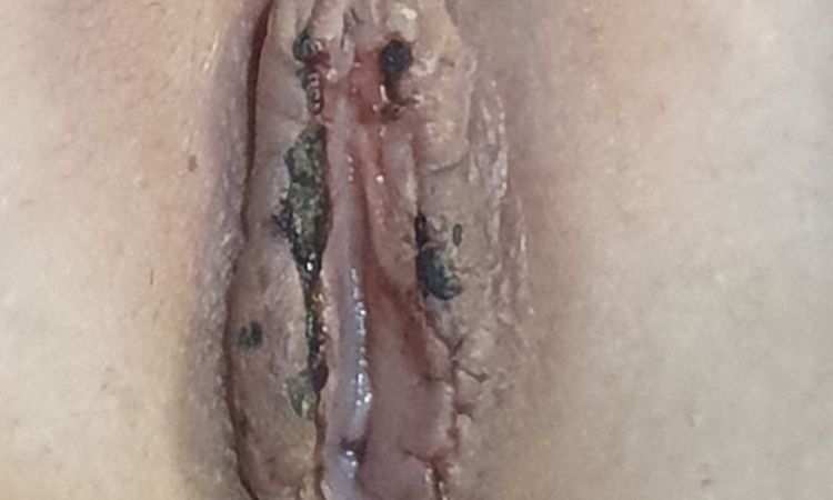 Otok labia po labioplastice - 72634