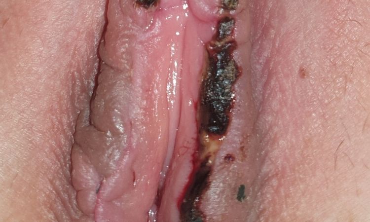 Otok labia po labioplastice - 72635