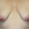 Modelace tuberoznich prsou - rizika