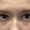 travajastni blepharoplastie