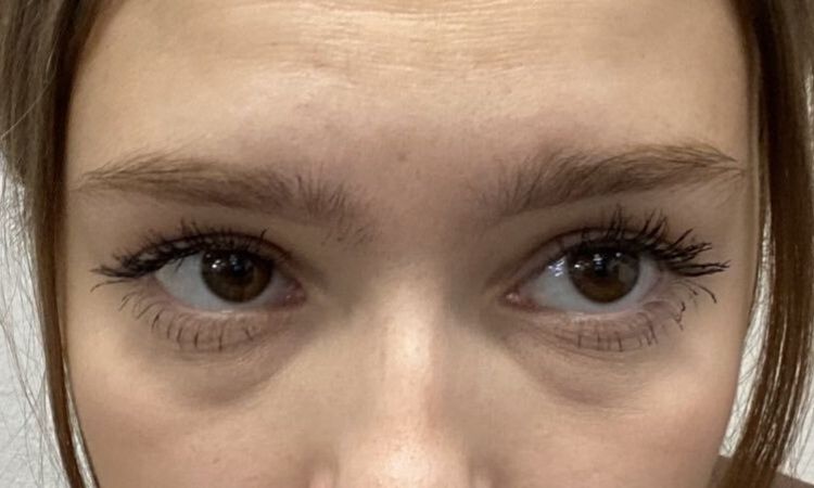 travajastni blepharoplastie - 75499