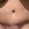 Abdominoplastika a siti svalu