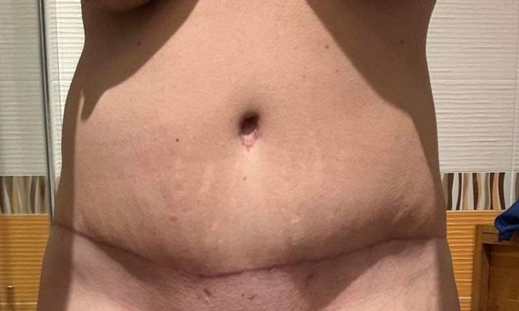 Abdominoplastika a siti svalu - 75704