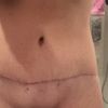 Abdominoplastika a siti svalu