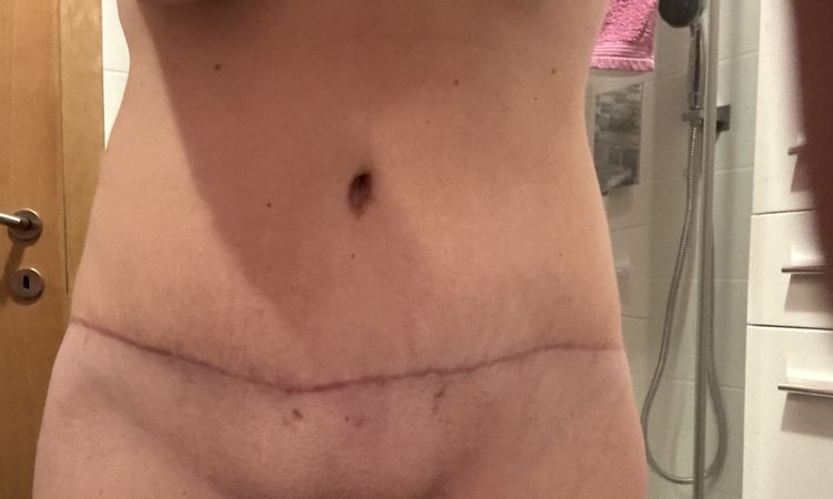 Abdominoplastika a siti svalu - 75705