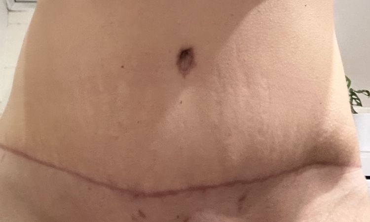 Abdominoplastika a siti svalu - 75706