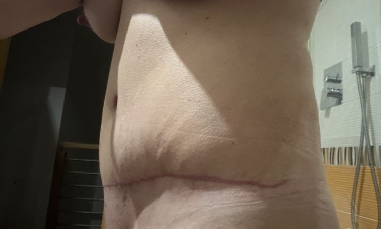 Abdominoplastika a siti svalu - 75707