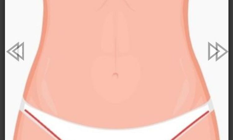 Abdominoplastika technikou dr.Scholze s liposukci bricha a boku,prip.zad - 76027