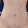 Abdominoplastika technikou dr.Scholze s liposukci bricha a boku,prip.zad