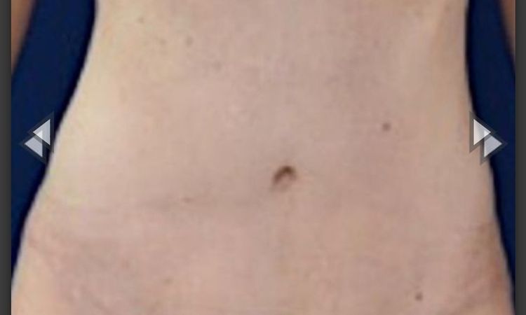Abdominoplastika technikou dr.Scholze s liposukci bricha a boku,prip.zad - 76028
