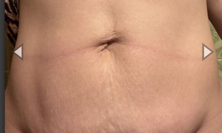 Abdominoplastika technikou dr.Scholze s liposukci bricha a boku,prip.zad - 76029