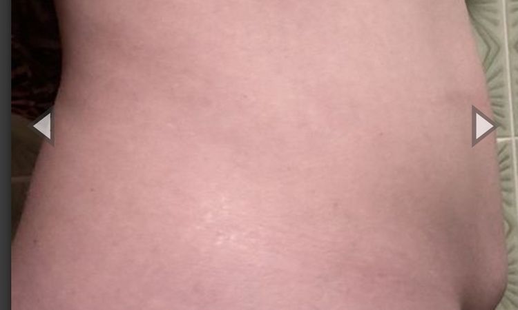 Abdominoplastika technikou dr.Scholze s liposukci bricha a boku,prip.zad - 76030