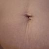 Umbilikoplastika po floating abdominoplastice,za jak dlouho po zakroku