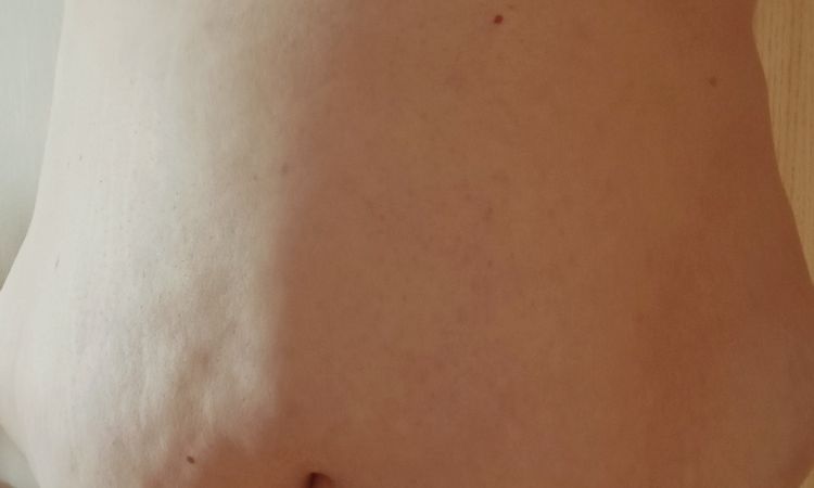 Dotaz na možnost kombinace operace pupeční kýly a abdominoplastiky - 77270