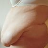 Dotaz na možnost kombinace operace pupeční kýly a abdominoplastiky