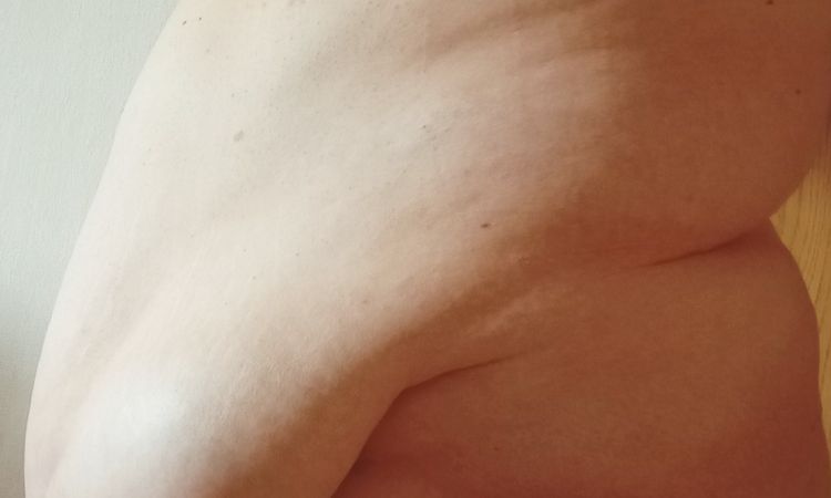 Dotaz na možnost kombinace operace pupeční kýly a abdominoplastiky - 77271