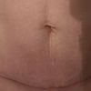 Jizva po abdominoplastice-laserove osetreni