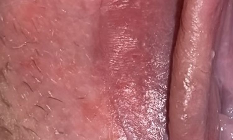 Pupinky po labioplastice - 77626