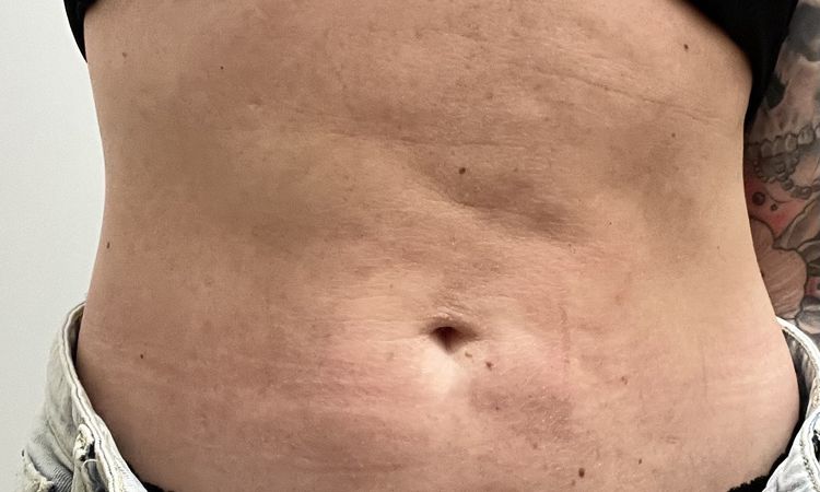Nepovedena liposukce bricha - 77652