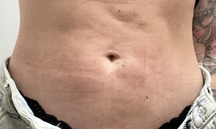 Nepovedena liposukce bricha - 77653