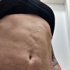 Nepovedena liposukce bricha