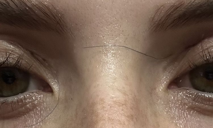 Blefaroplastika horních víček - 78426