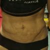 Laserova liposukce bricha