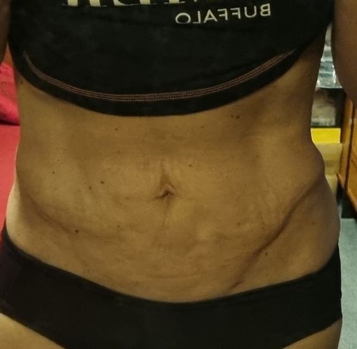 Laserova liposukce bricha