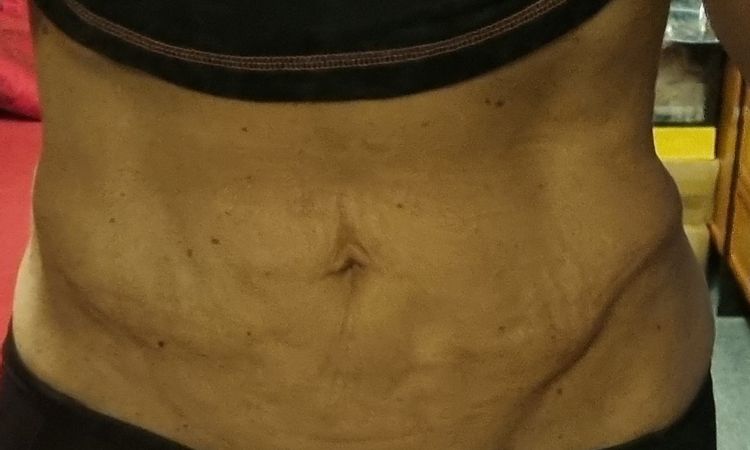 Laserova liposukce bricha - 78902