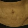Laserova liposukce bricha