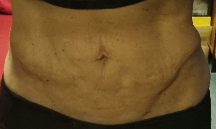 Laserova liposukce bricha